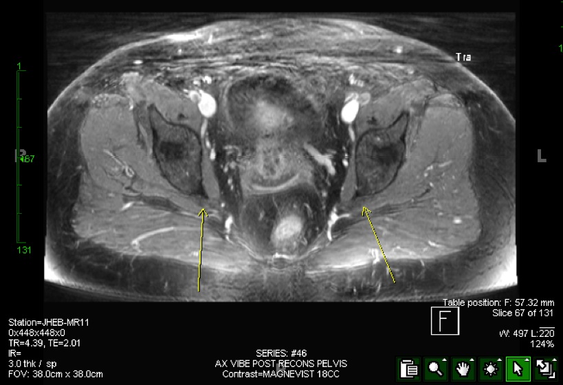 Figure 5 for case split right sciatic